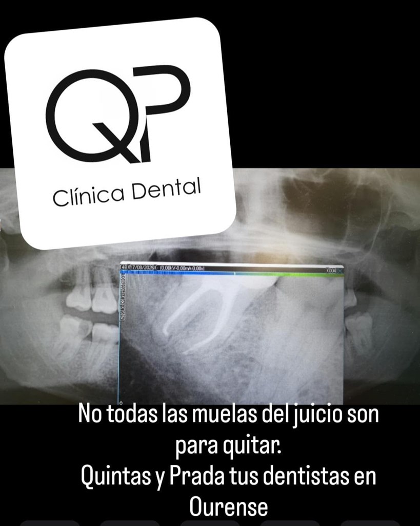 ¿Hay que quitar siempre las muelas del juicio? Cuando un cordal se puede conservar 