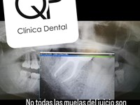 ¿Hay que quitar siempre las muelas del juicio? Cuando un cordal se puede conservar 