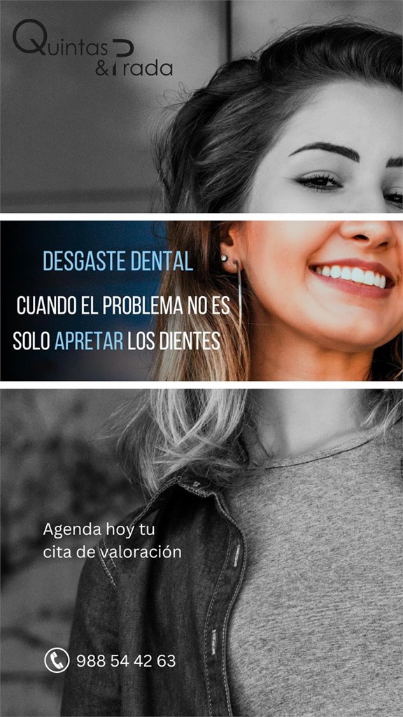 ¿Tus dientes se están desgastando? No siempre es culpa del bruxismo