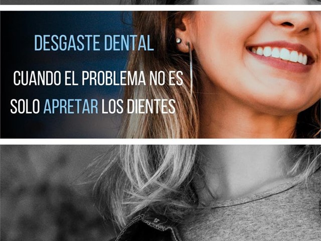 ¿Tus dientes se están desgastando? No siempre es culpa del bruxismo